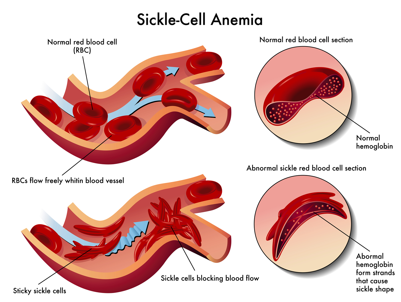 <p><span>Sickle cell anemia, a base sequence mutation that causes the shape of hemoglobin (especially in environments with low oxygen) to morph from concave red blood cell shapes to sickle shapes that will clot in very small capillaries, causing tissue damage and incredible pain.</span></p>