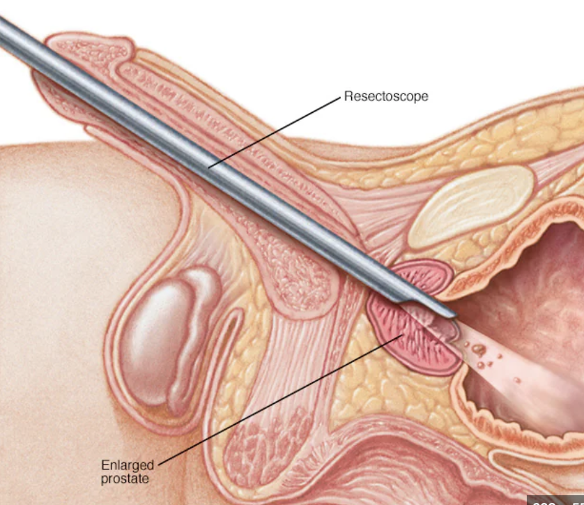 <p>transurethral resection of the prostate</p><p><em>surgical procedure&nbsp;</em></p>
