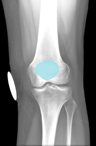 Comment:
Acts as fulcrum to increase angle of
quadriceps femoris tendon across knee