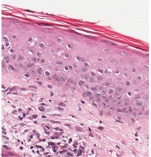 <p>does the dermal/epidermal junction intact?</p>