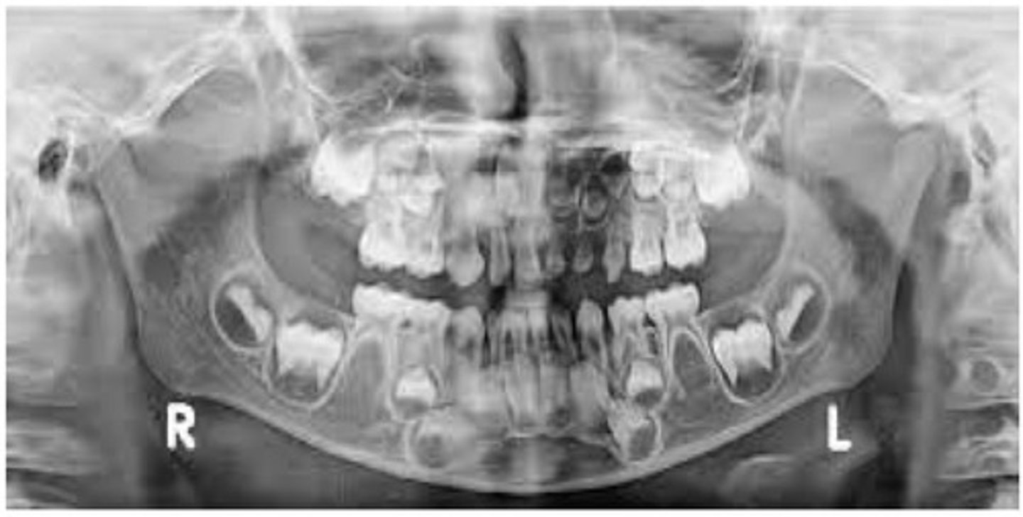 <p>Exhibit a marked reduction in radio density and a characteristic ghostlike appearance. Very thin enamel and dentin are present. Usually treated by extraction.</p>