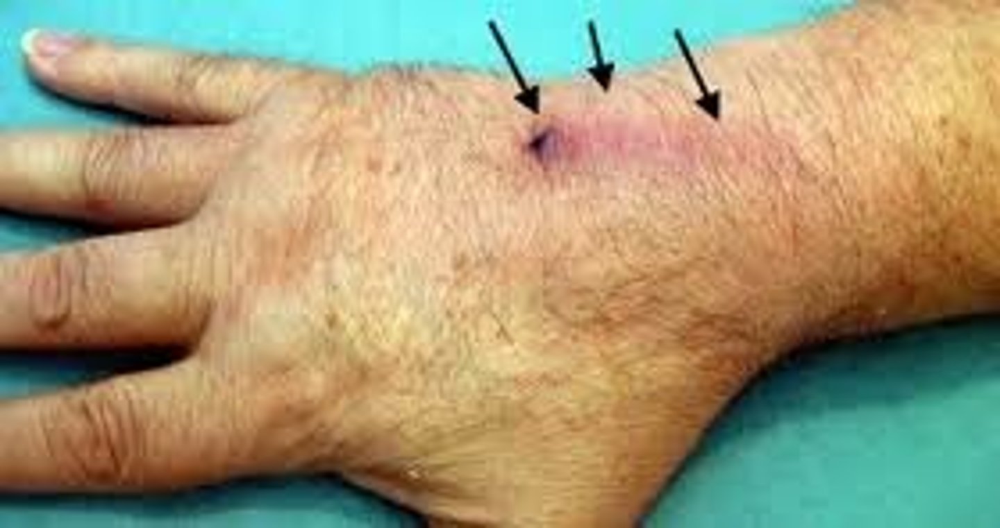 <p>Phlebitis</p>