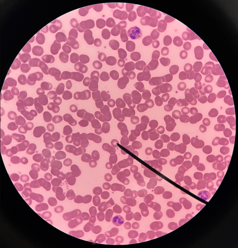 • Most abundant cell in whole blood.

• Appears red and rounded.

• Contains hemoglobin.

• Transports oxygen and carbon dioxide.

• Also known as red blood cells (RBCs).