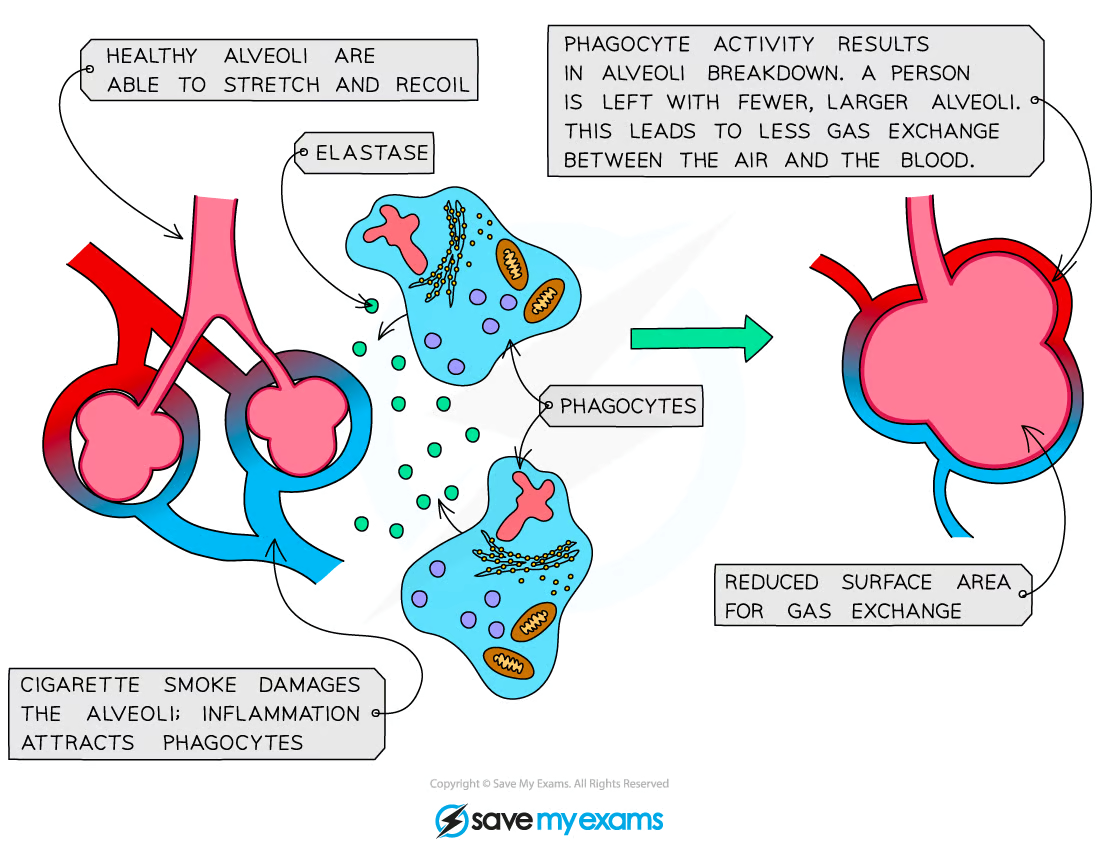 <ul><li><p>emphysema is a result of <strong>frequent infection</strong></p><ul><li><p>infections occur more frequently in smokers due to the build-up of mucus that occurs in the lungs</p></li></ul></li><li><p>phagocytes that enter the lungs release elastase, an enzyme that breaks down the elastic fibres in the alveoli</p></li><li><p>the <strong>alveoli </strong>become <strong>less elastic and cannot stretch</strong>, so many burst</p></li><li><p>the breakdown of alveoli <strong>reduces the surface area for gas exchange</strong></p></li></ul><p></p><ul><li><p>emphysema patients become <strong>breathless and wheezy</strong>, and may need a constant supply of oxygen to stay alive</p></li></ul><p></p>