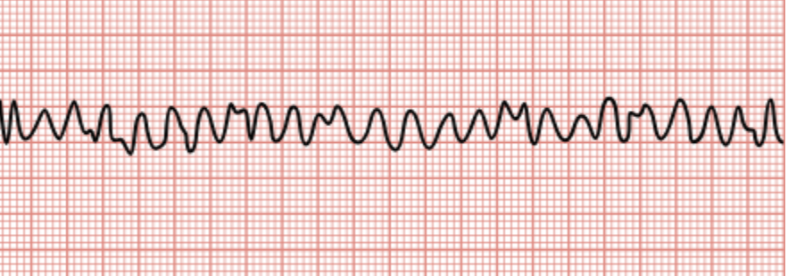<p>Ventricles twitch or quiver, not pumping blood. No pulse is produced, and patients become unconscious.</p>