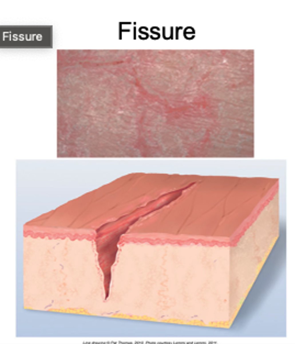 <p>Linear crack or break from epidermis to dermis</p><p>Seen in tinea pidus (athlete's foot)</p>
