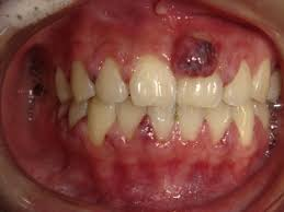 <p>red/purple papules of granulation tissue</p><p>form in interdental papillae</p><p>red</p><p>soft</p><p>painless</p><p>bleed easily</p>