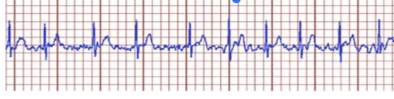 <p>Practice Q 7: </p><p>A physical therapist is ambulating a patient, and they report palpitations, shortness of breath and fatigue. What should be the interpretation and immediate action according on the ECG strip shown below?</p><p>A. Ventricular fibrillation; Call for a defibrillator</p><p>B. Premature ventricular contractions; Take them to their bed and monitor for changes in ECG</p><p>C. Atrial Fibrillation; Stop exercise and report to the physician</p><p>D. 3rd degree heart block; activate emergency</p>