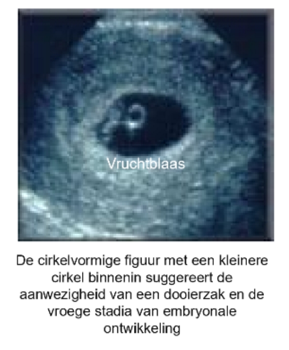 <ul><li><p>zeer vroege prenatale echografie, vaak aangeduid als vruchtblaas (gestational sac) → in 1e trimester van zwangerschap</p></li><li><p>echobeelden worden gebruikt om:</p><ul><li><p>zwangerschap te bevestigen</p></li><li><p>gezondheid &amp; ontwikkeling van embryo te controleren</p></li><li><p>om zwangerschap te dateren</p></li></ul></li></ul><p></p>