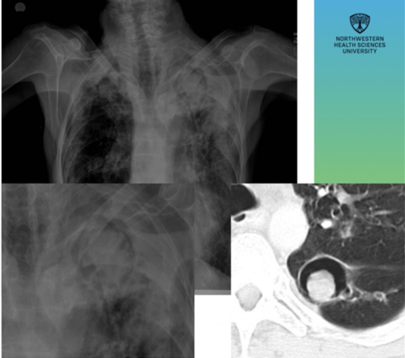 <p>A 58-year-old patient with a history of a healed cavitary lung lesion from prior tuberculosis undergoes routine chest imaging. The patient feels well overall but reports occasional episodes of hemoptysis.</p>