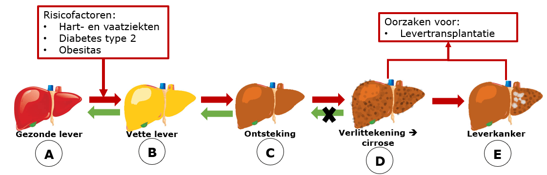 <ul><li><p>oorzaken = chronisch virale hepatitis B/C, leververvetting/steatose, chronisch alcoholmisbruik</p></li><li><p>stappen</p><ul><li><p>fatty liver → indien lang = cirrose + fibrose ontstaat</p><ul><li><p>weinig fitaal lever weefsel = minder functie</p></li></ul></li><li><p>alcoholic fatty liver disease vs non-alcoholic fatty liver disease</p></li></ul></li><li><p><span style="color: yellow"><strong><em>MELD-score/model for end-stage liver disease</em></strong></span> → hoe snel levertransplantatie nodig</p><ul><li><p>hoe hoger = hoe urgenter (+ kleinere kans overleving)</p></li><li><p>bevat =</p><ul><li><p><span style="color: #05fafd">leverenzymen</span></p></li><li><p><span style="color: #05fafd">inr</span></p></li><li><p><span style="color: #05fafd">bilirubine</span></p></li><li><p><span style="color: #05fafd">kreatinine</span><span style="color: blue"> </span>(als maat nierfunctie)</p><ul><li><p>maar bilirubine kan te hoog zijn → kan kreatinine niet goed bepalen → verudn serum tot bilirubine net onder niveau = wel kreat meetbaar</p></li></ul></li><li><p><span style="color: #05fafd">cystatine C </span>(voor eGFR berekenen) = minder gevoelig voor bilirubine (maar kan je niet gebruiken voor formule)</p></li></ul></li></ul></li><li><p><span style="color: #f9b502"><u>chronisch alcohol misbruik = gamma-GT!</u></span></p></li></ul><p></p>