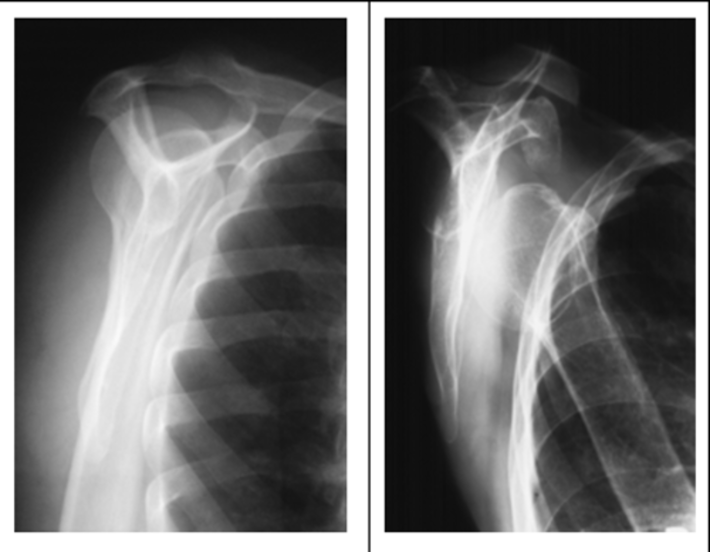 <p>- For lateral shoulder and proximal humerus</p><p>- CR to proximal humerus—2 inches (5 cm) below top of shoulder</p><p>- Body of scapula superimposed on end</p><p>- Acromion and coracoid processes in profile</p><p>- Humeral head and glenoid cavity superimposed</p><p>- Optimal exposure factors</p>