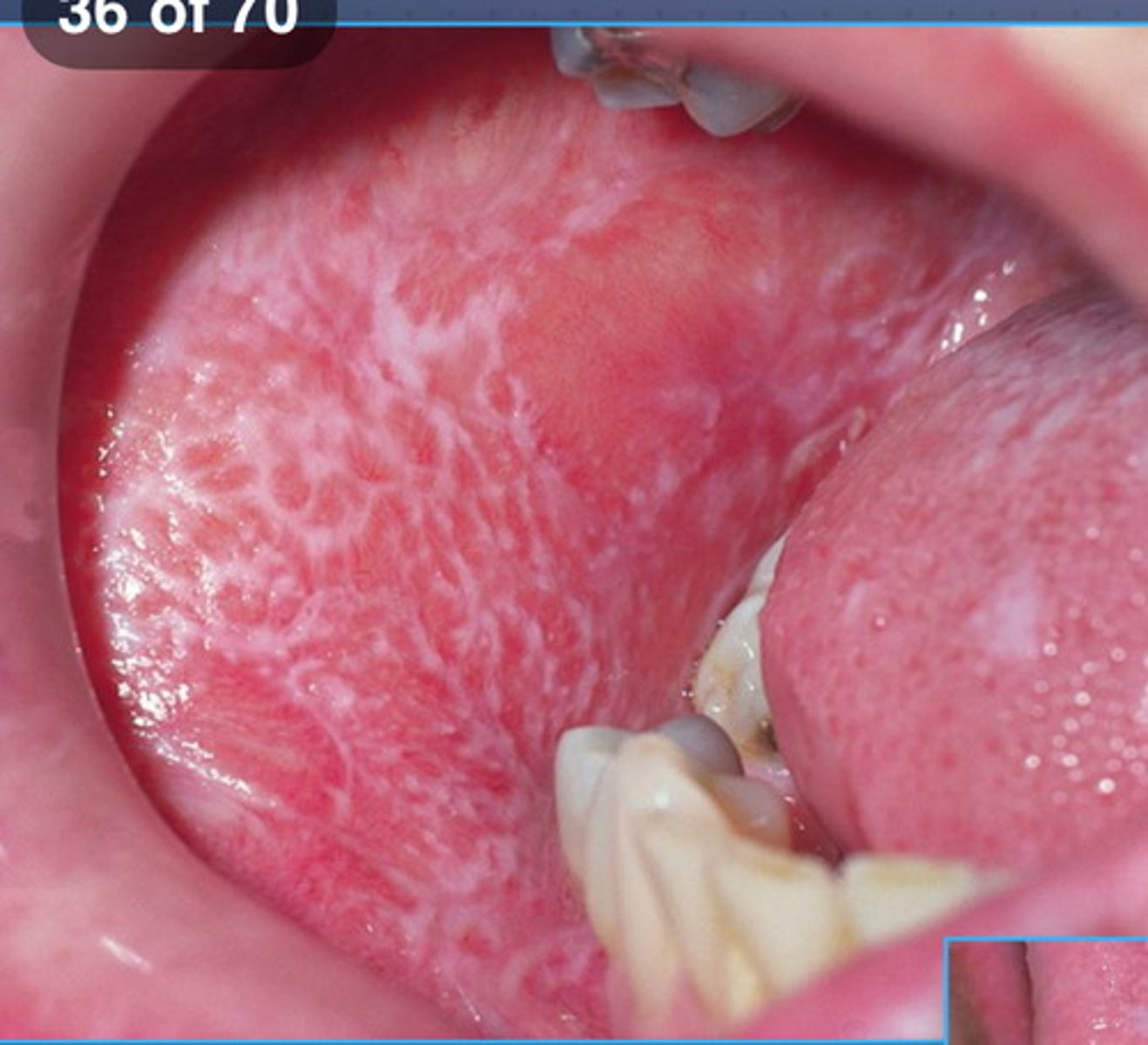 <p>Wickham Striae</p><p>• usually bilateral</p><p>• Population: middle-aged females</p><p>• Common location: buccal mucosa (ging/tongue) </p>