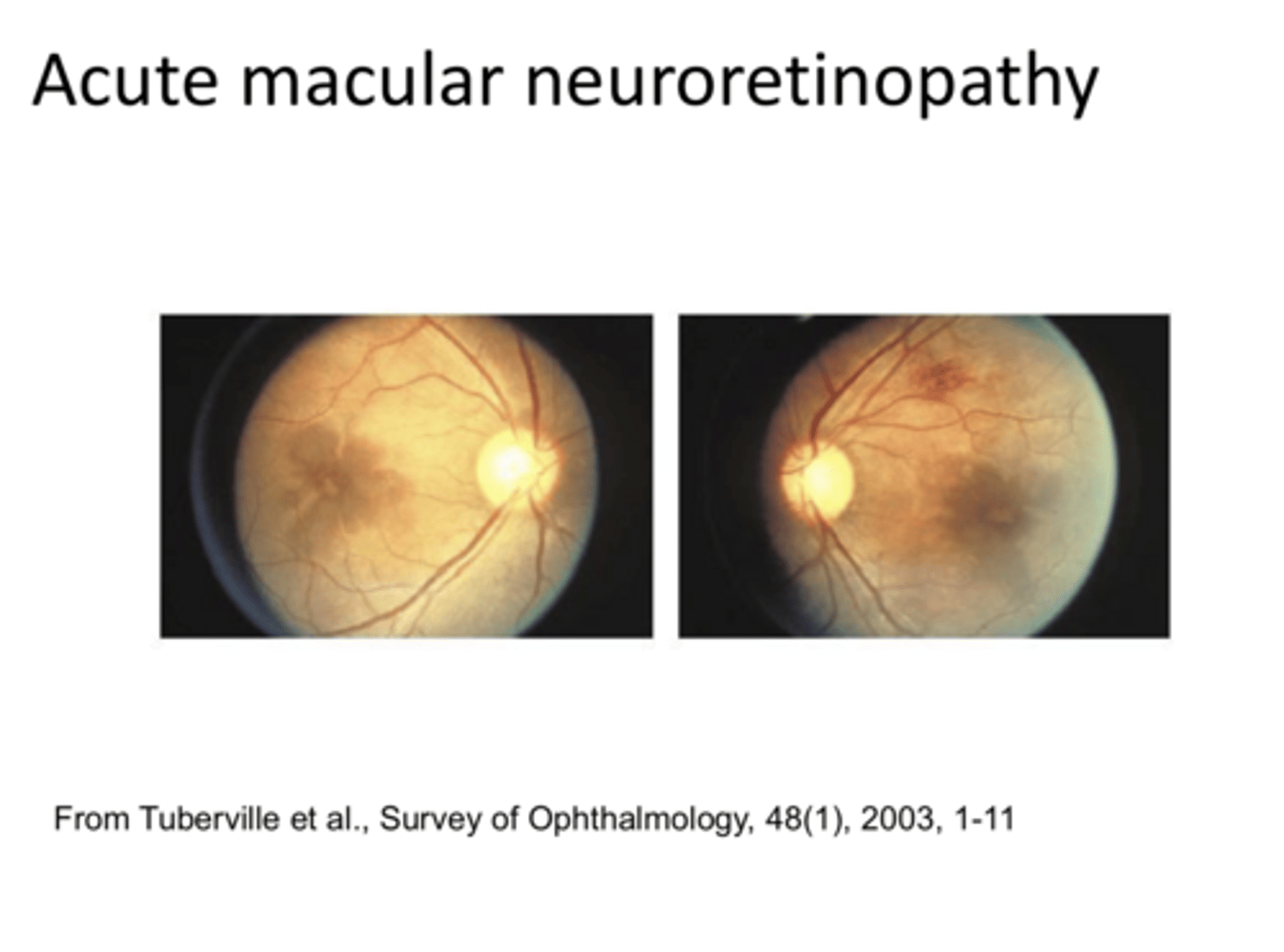 <p>acute macular neuroretinopathy is (unilateral/bilateral)</p>