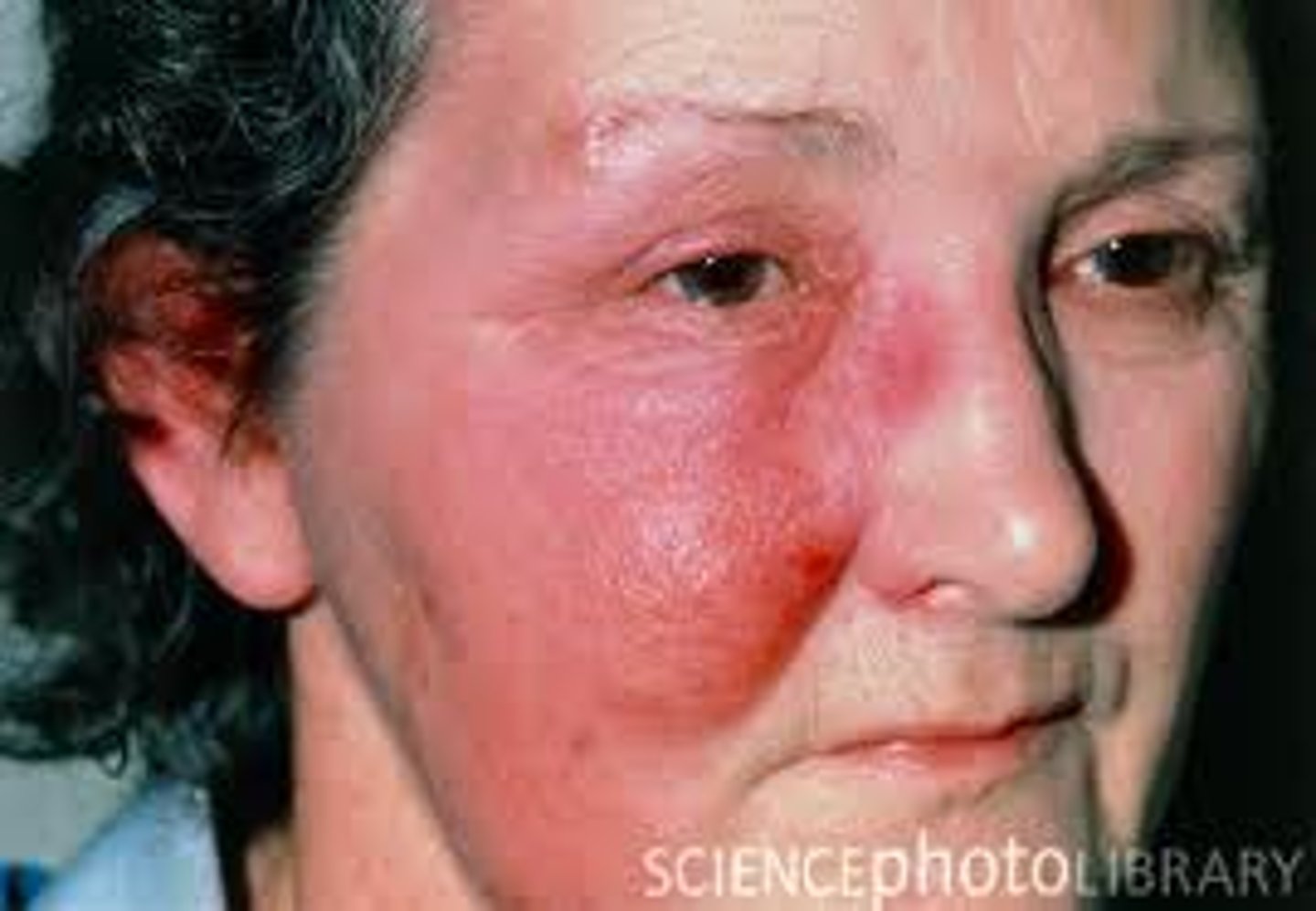 <p>S. pyogenes infects the dermal layer of the skin - Causes local tissue destruction and causes sepsis if the bacterium enters blood stream</p>