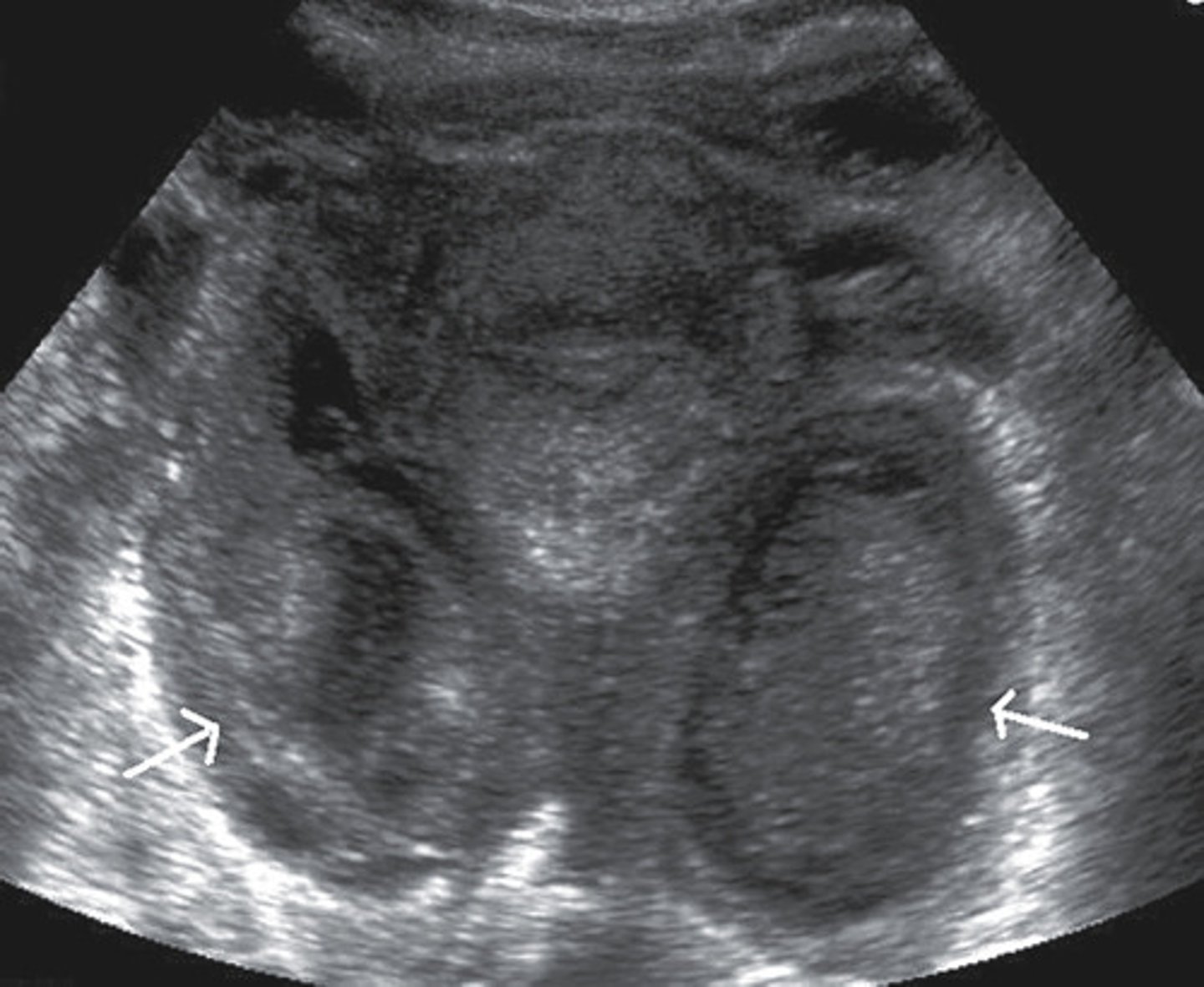 <p>- thick irregular endo</p><p>- ill defined uterine borders</p><p>- pyo/hydrosalpinx</p>