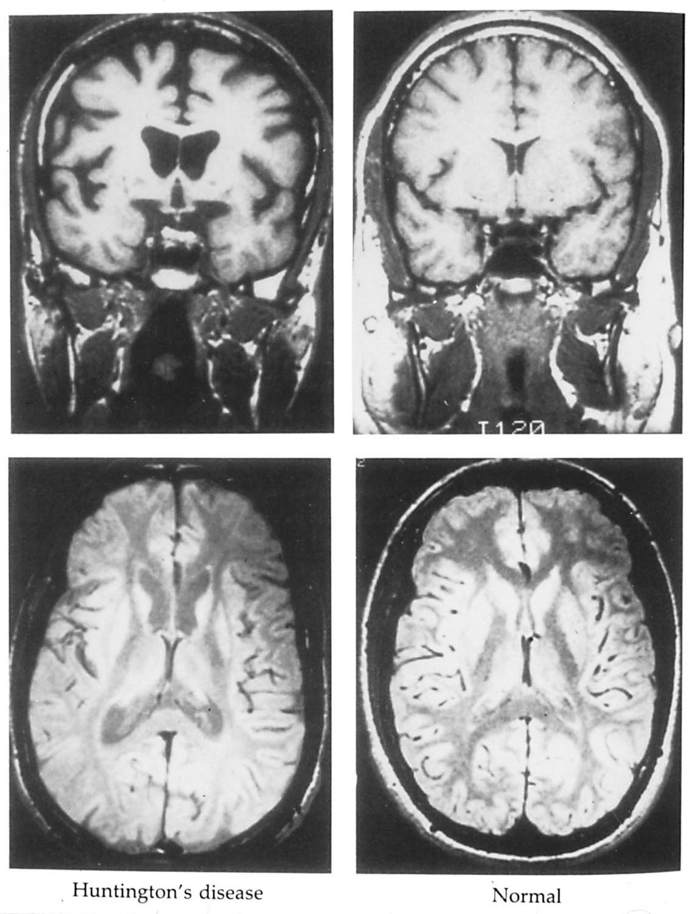 <p>huntington’s chorea is a hyperkinetic disorder</p>