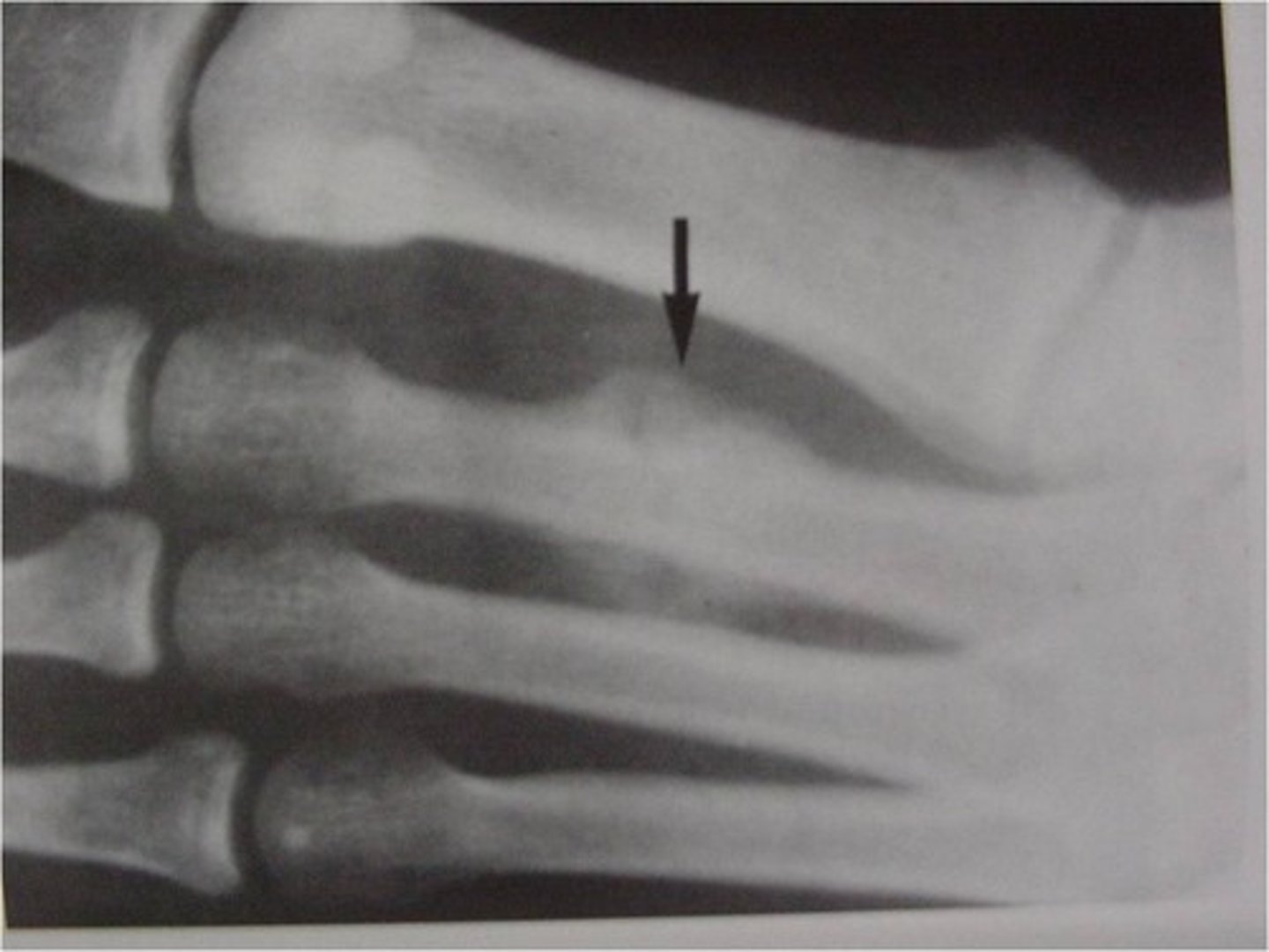 <p>Stress or fatigue fx (march fx)</p>