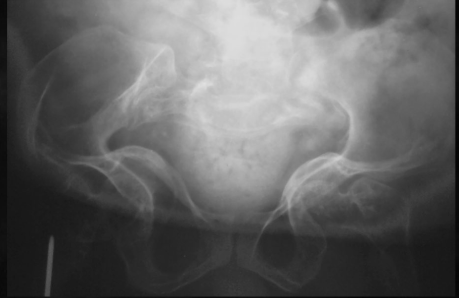 <p>what is seen here for this case of osteogenesis imperfecta?</p>