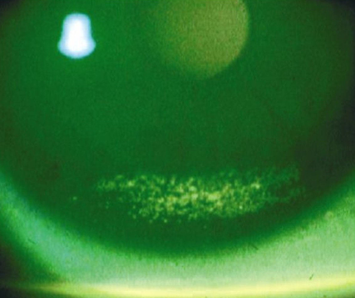 inferior cornea