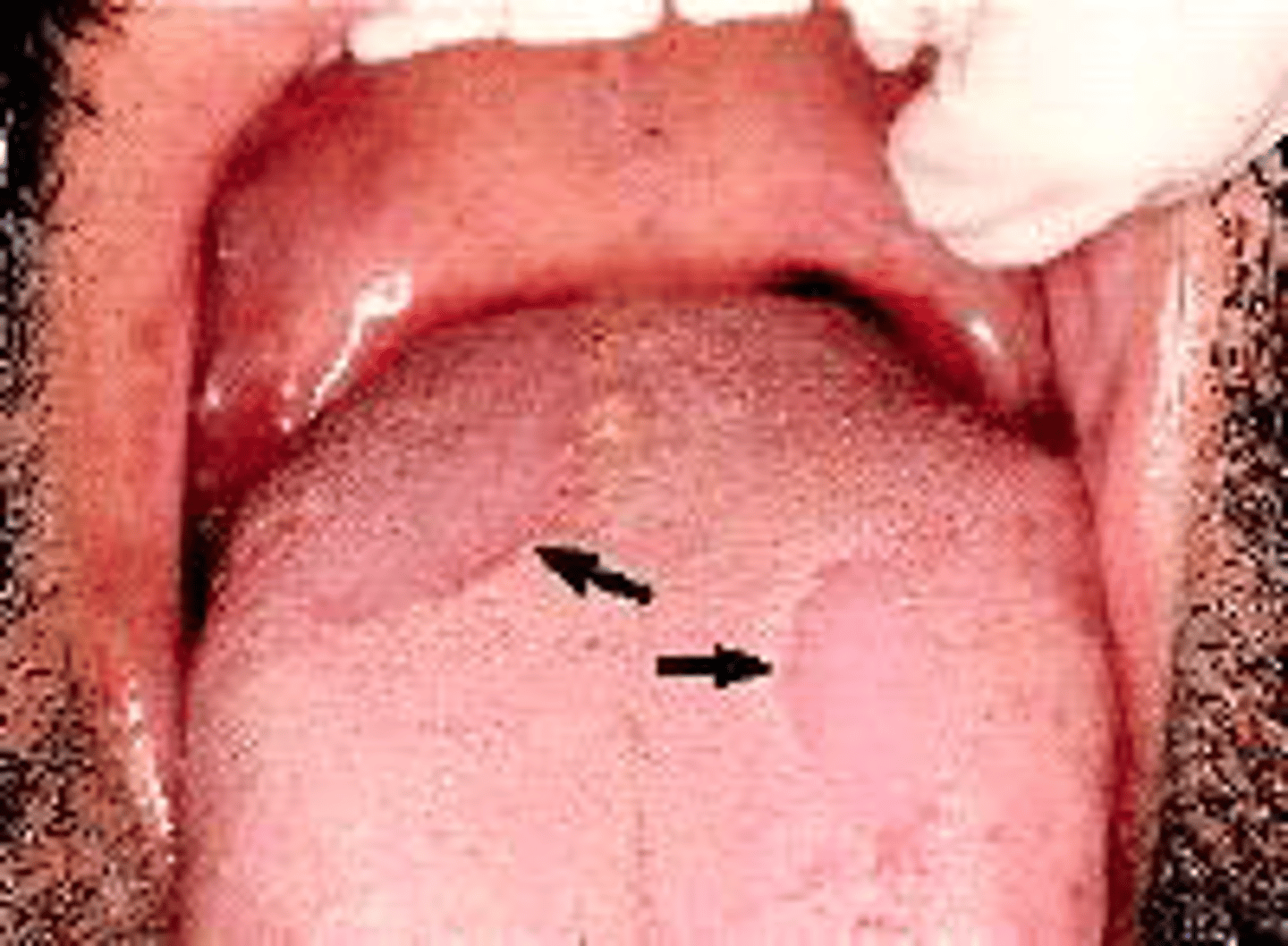 <p>The dorsal tongue lesions marked by the arrows are best diagnosed as</p>