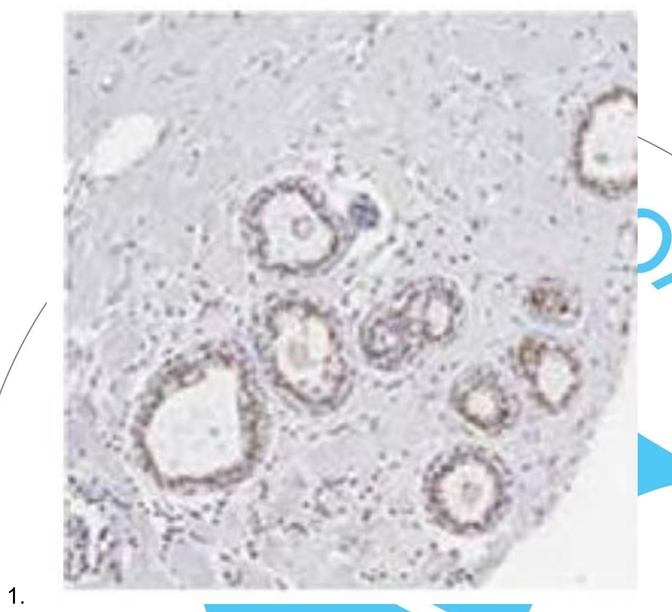 <p>Câu 3. ER (+++), PR (+), HER2 (–), Ki67 30% → thuộc nhóm phân tử nào của UT vú? <br />
A. Luminal A <br />
B. Luminal B (HER2 âm) <br />
C. HER2-enriched <br />
D. Basal-like (Triple-negative)</p>