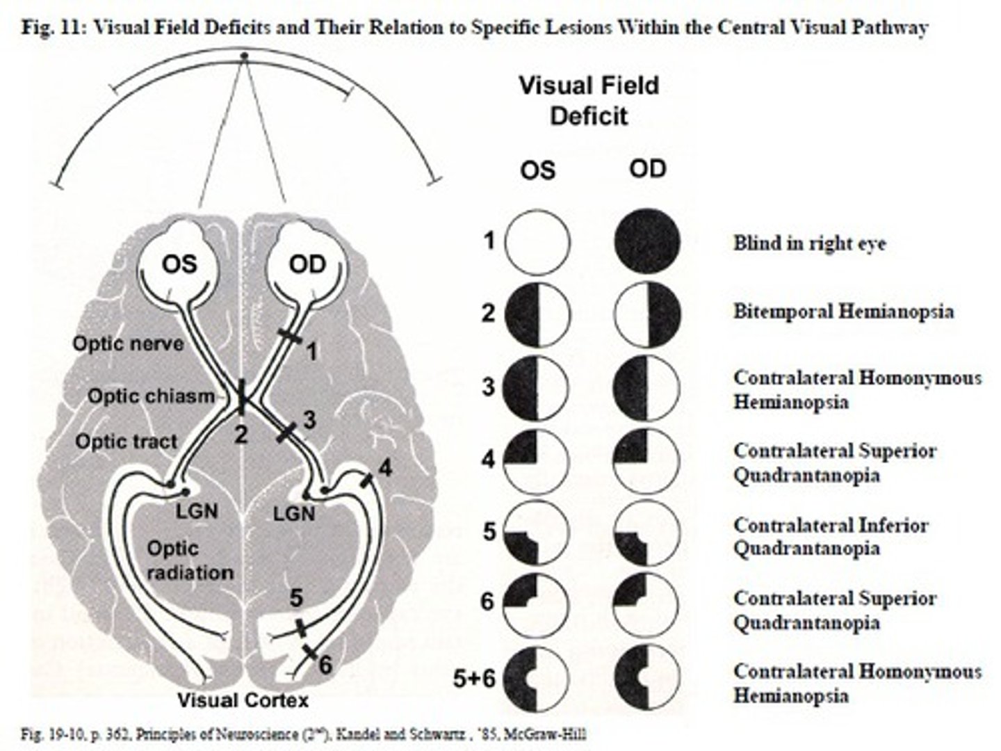 <p>"Pie in the sky" - Damage to inferior optic radiation; Lesions of the optic radiations include infarcts, tumors, demyelination, trauma, and hemorrhage</p>