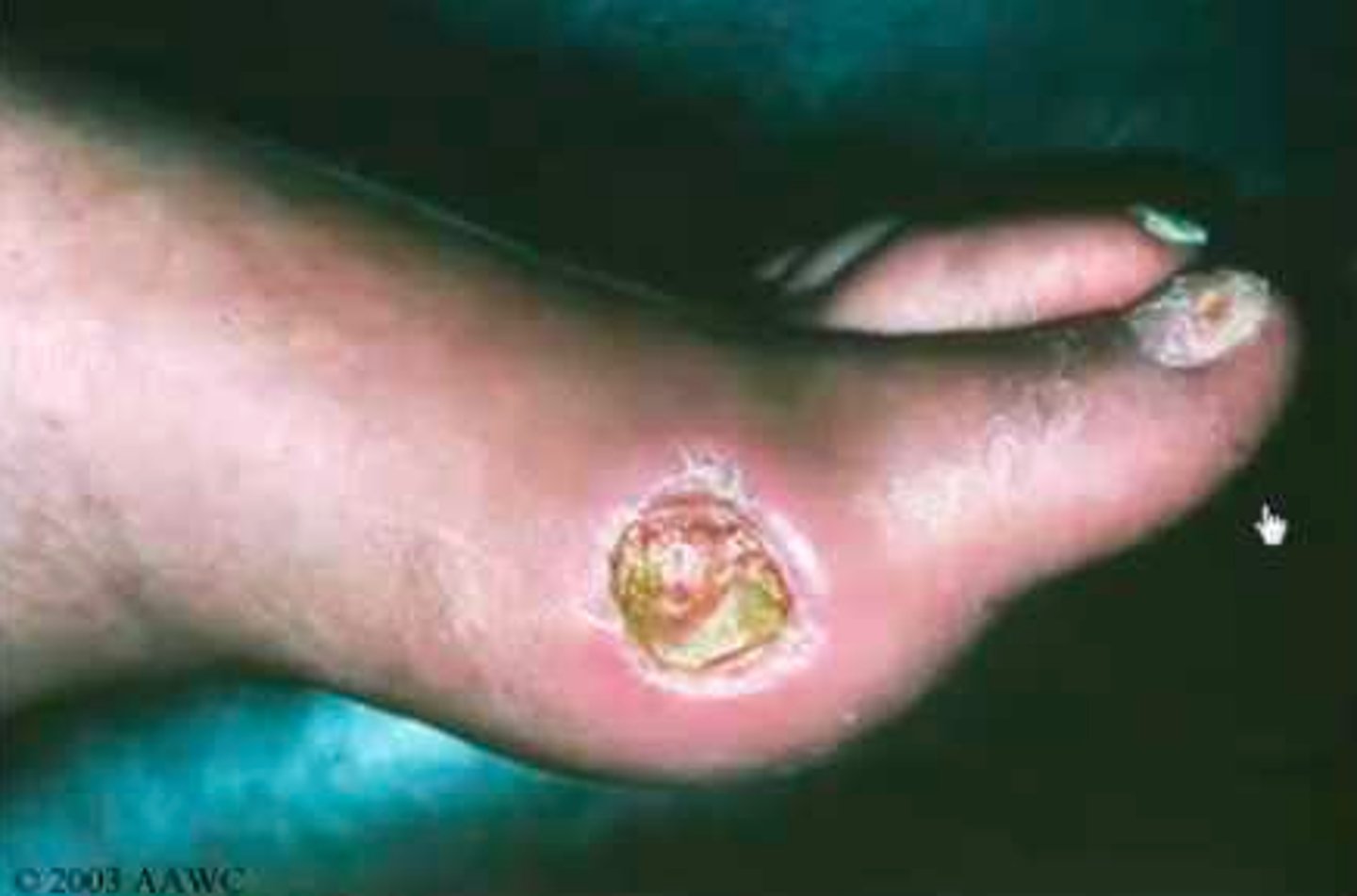 <p>diagnose this:</p><p>"punched out look", round, well defined border</p>