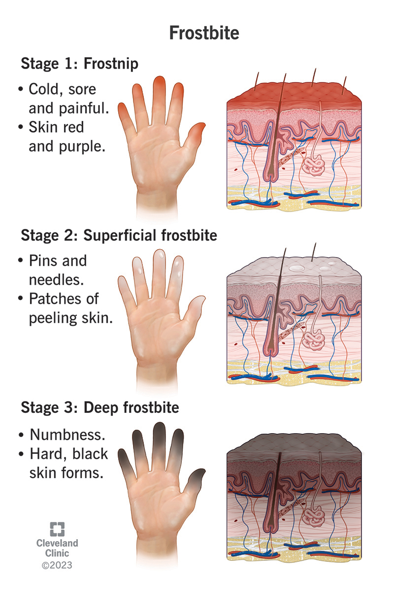 <ol><li><p>skin is white, </p></li><li><p>mottled</p></li><li><p>numbness and lack of feeling</p></li><li><p>large blisters 24-48hrs after rewarming. may turn black and hard as tissue dies </p></li></ol><p></p>