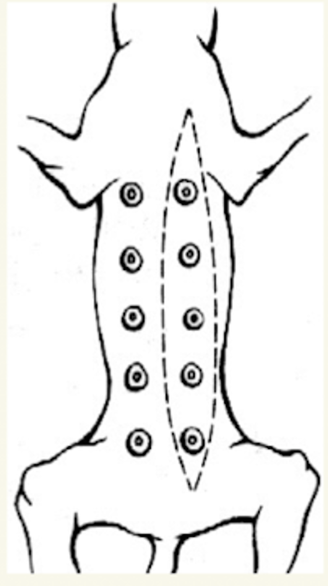 <p>mastectomía unilateral</p>