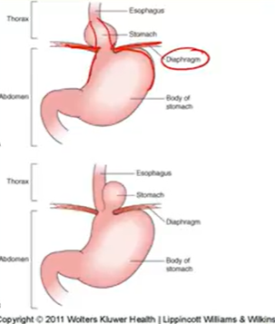 <p>Stomach protrude through diaphragm</p><ul><li><p>GERD or asymptomatic</p></li></ul><p>d/x: Barium swallow/endoscopy</p><p>t/x: Same as GERD and surgery if large</p>
