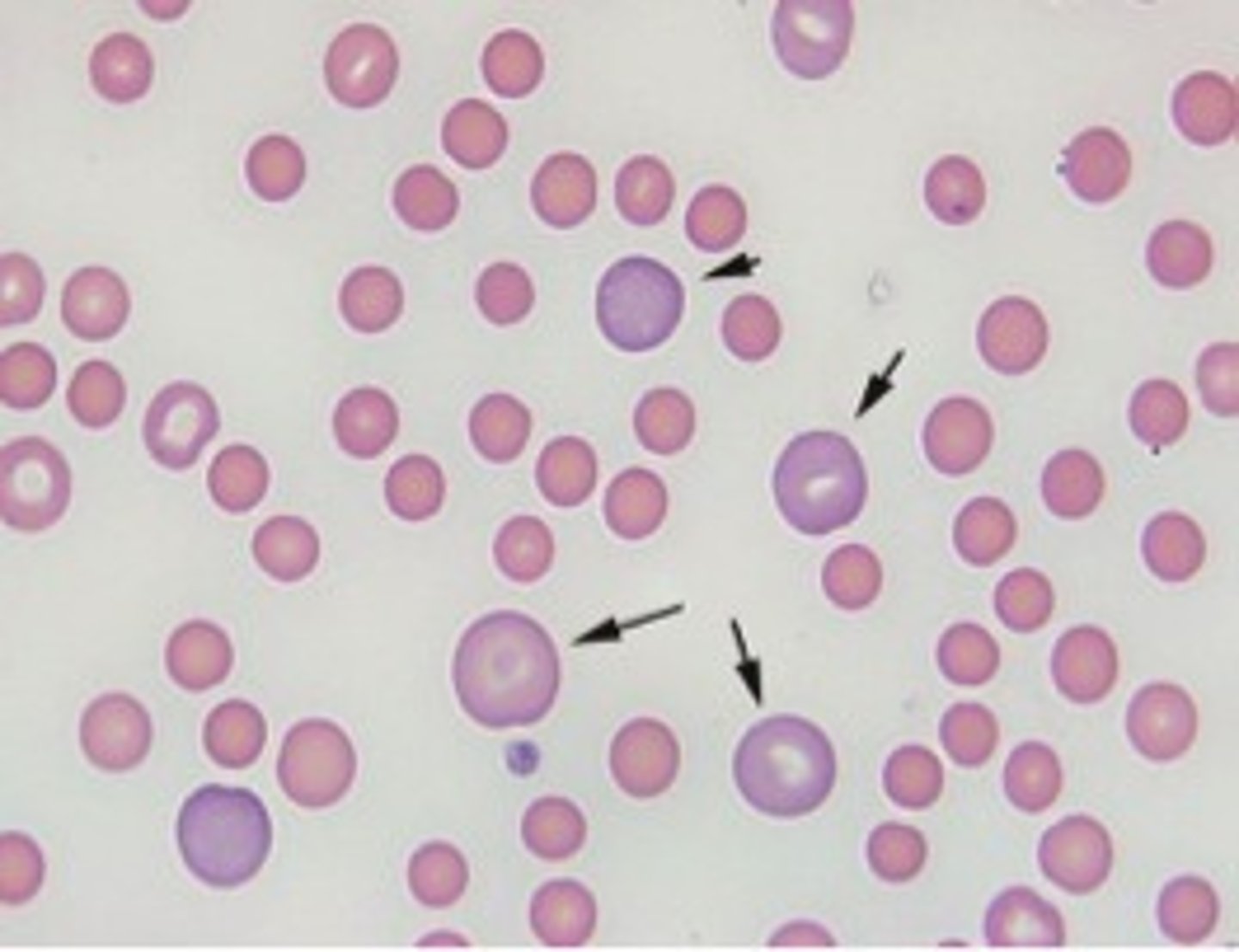<p>Bone marrow releases red blood cell precursor earlier than is normal</p>