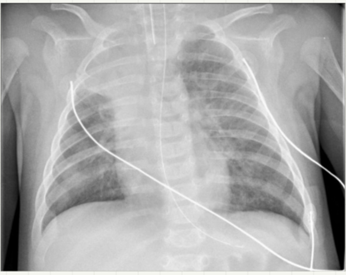 <p>acute bronchiolitis sx</p>