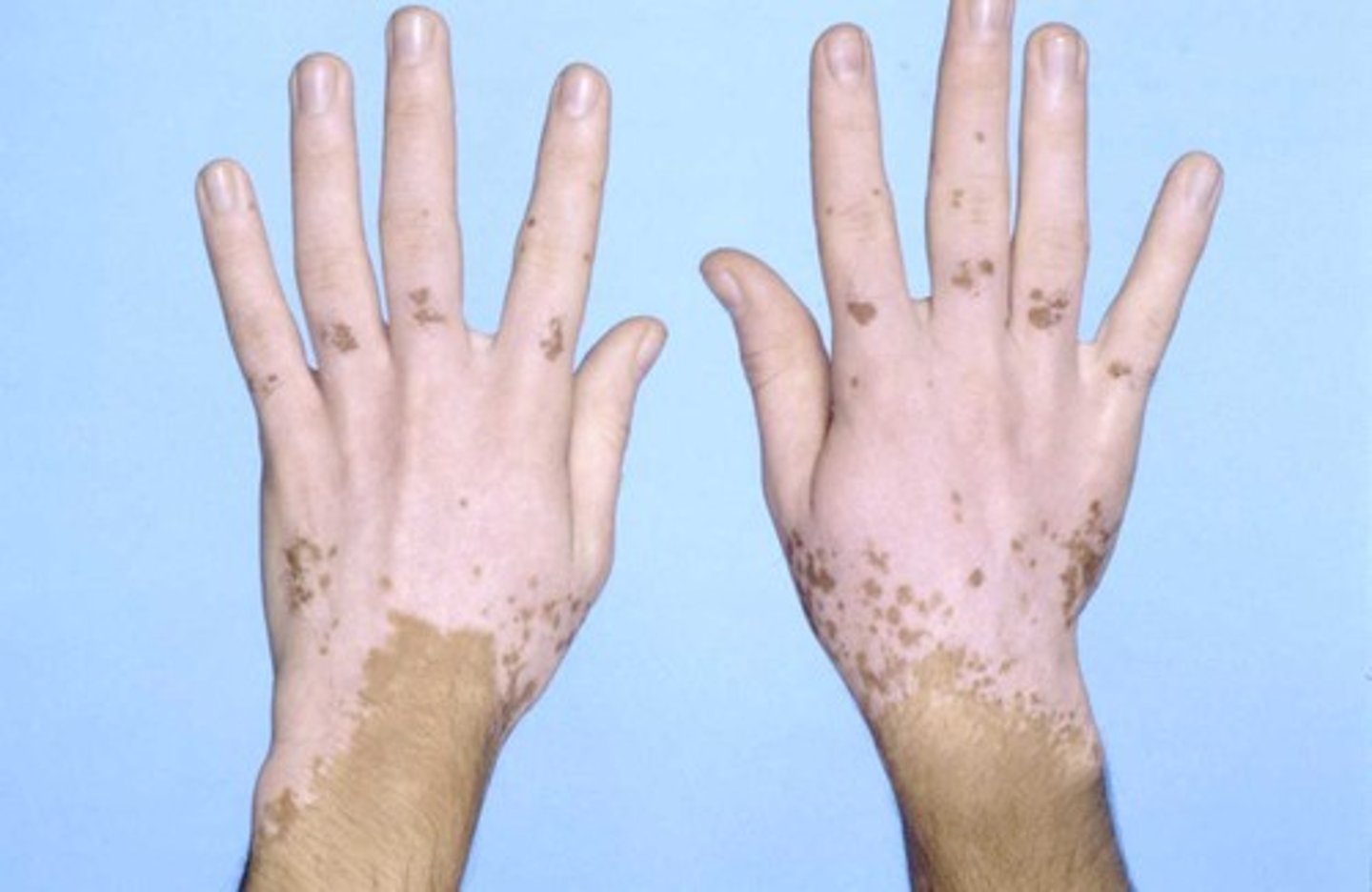 <p>Autoimmune disease that stops melanocytes from functioning</p>