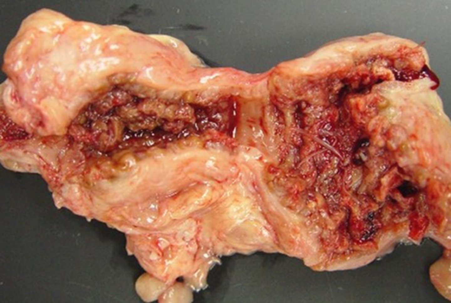 <p>What parasite is generally associated with the verminous aneurysm seen in the accompanying image?</p>