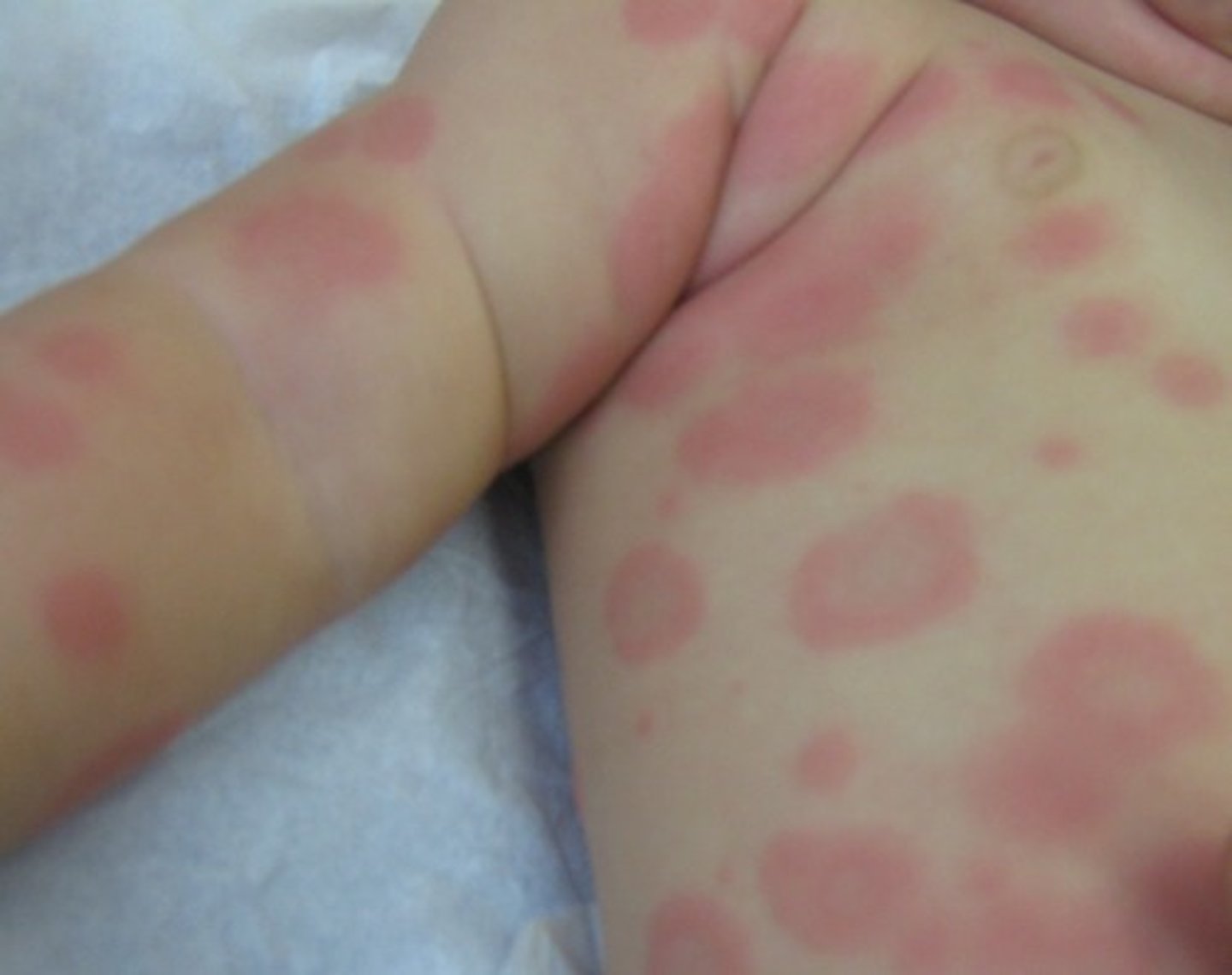 <p>Erythema Multiforme (often triggered by HSV in kids)</p>