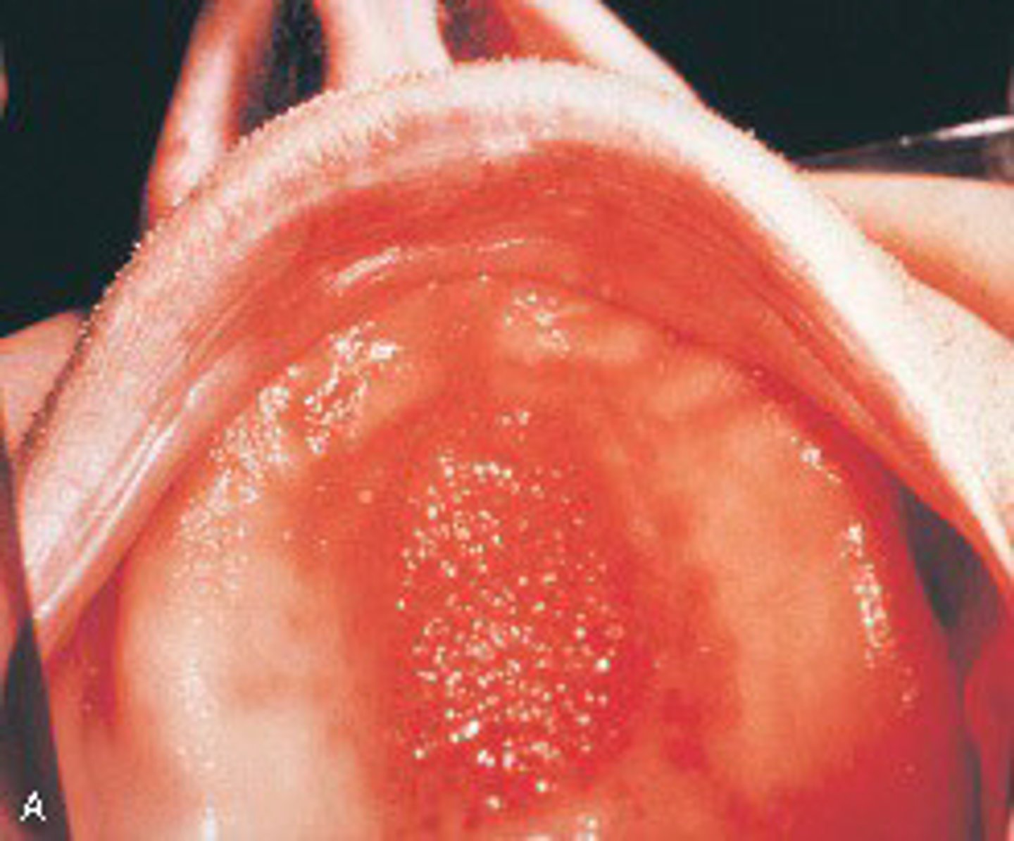 <p>An ill-fitting suction area of a maxillary denture</p>