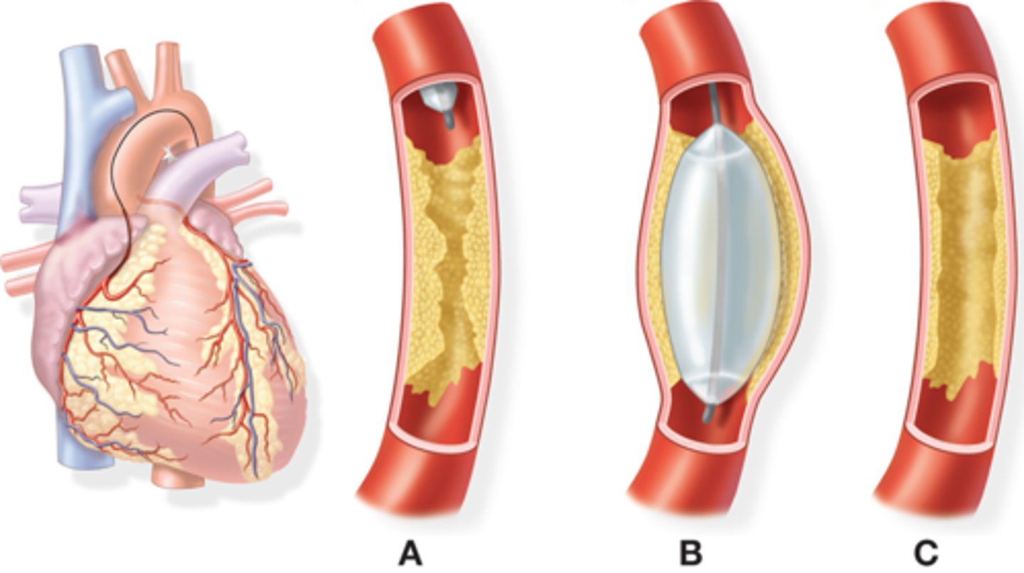<p>percutaneous transluminal coronary angioplasty</p><p>can be done with or without stenting</p><p>commonly inserted through femoral artery or vein</p>