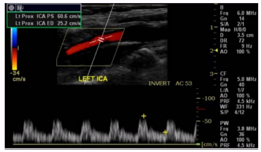 <p>the direction of flow for this internal carotid artery in this image is</p>