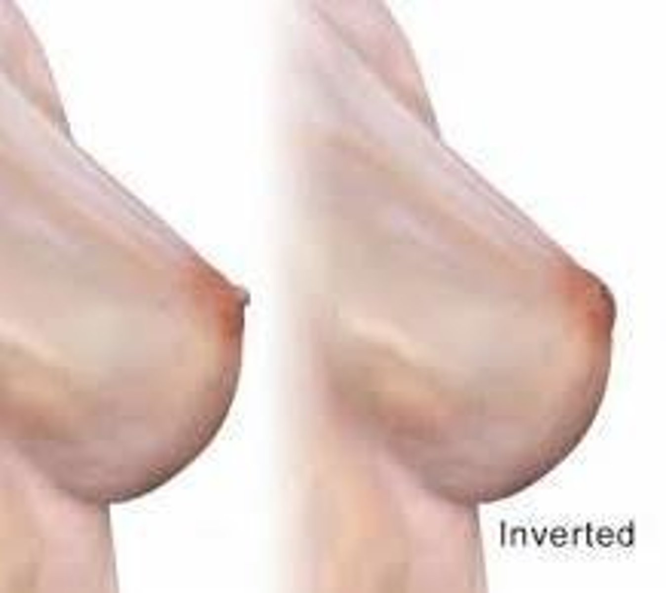 <p>Eversion to inversion may indicate cancer.</p>