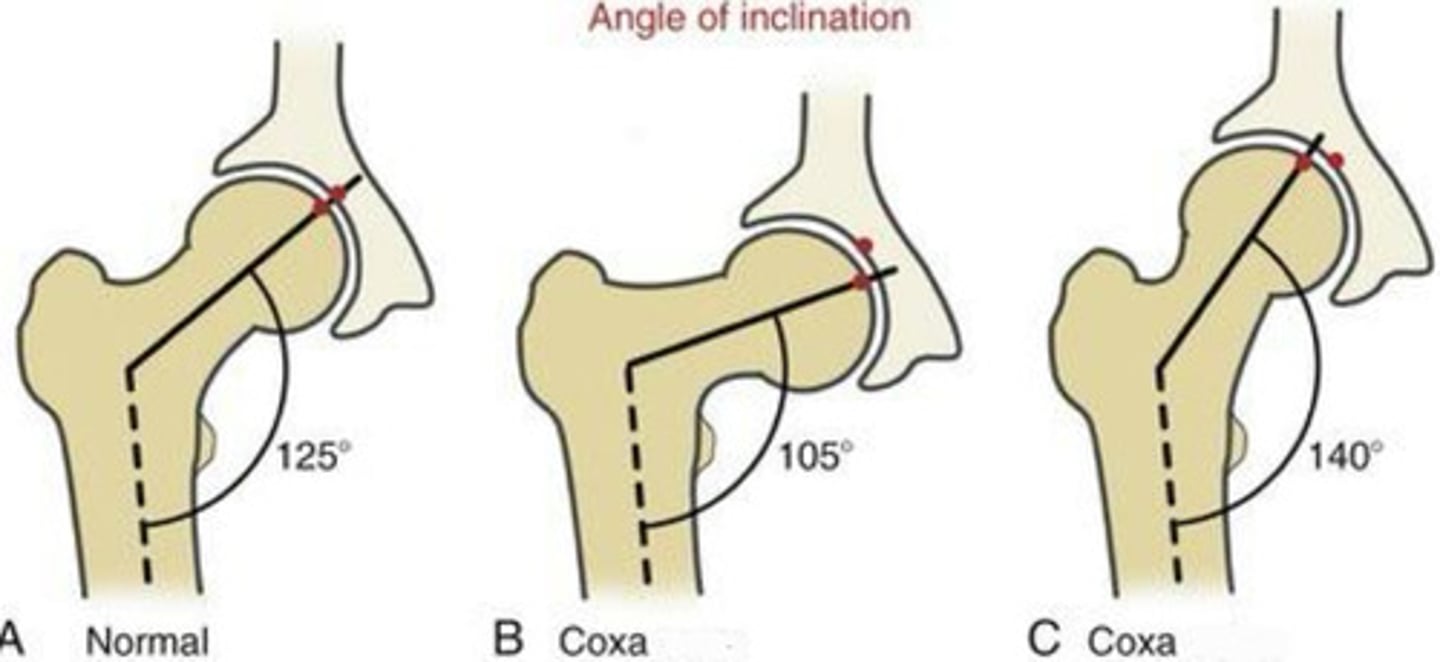 <p>coxa valgus</p>