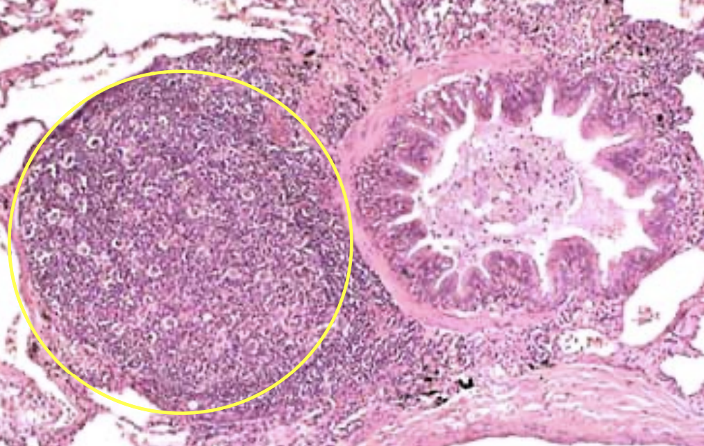 <p><strong><u>Yellow circle:</u> BALT </strong></p><p><strong><u>Beside it:</u> Bronchiole </strong></p>