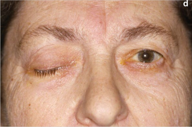 <p>(139) Identify the condition:</p>