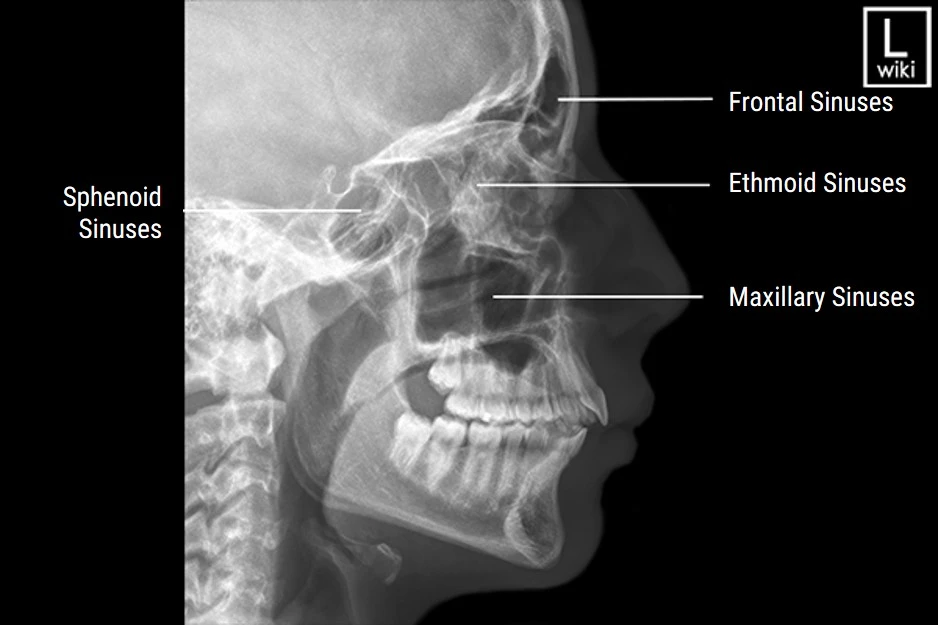 <p>Ethmoid, sphenoid, frontal (paranasal) sinuses</p><p></p><p>IOML</p><p></p><p>.5 to 1” posterior to canthus - corner of “I”</p>