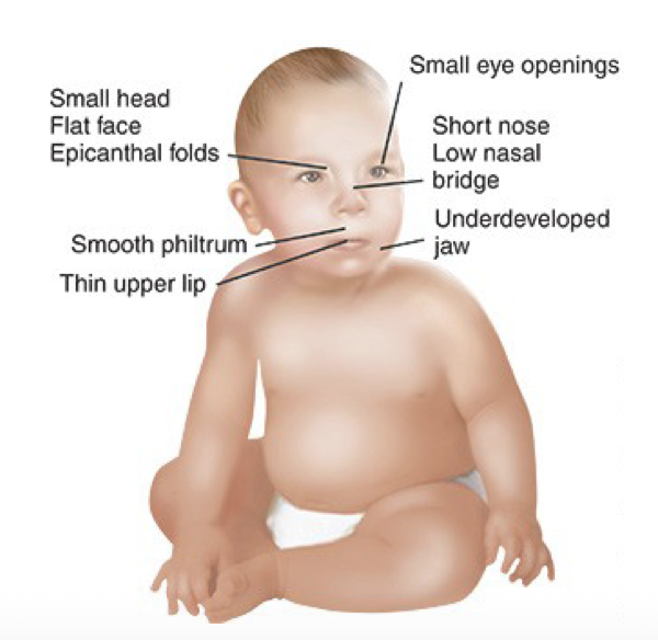 <ul><li><p>excessive alcohol during pregnancy → severe effects on infant </p></li><li><p>growth retardation, cognitive/behaviour/learning issues, anatomical abnormalities</p></li></ul><p></p>