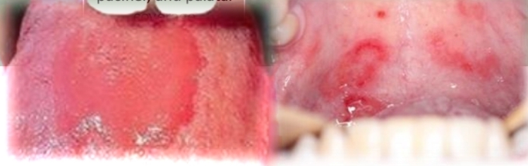 <p><strong><u>Erythematous candidiasis</u></strong></p><p class="has-focus">Candida albicans and other species</p><p class="has-focus">Contributing factors: Antibiotics, immunosupression, xerostomia, pacfier, palatal coverage appliance</p><p class="has-focus"></p><p class="has-focus is-empty"><strong>Treatment </strong>- Antifungal medication and proper oral hygiene. May recur if cause not eliminated or managed</p><p class="has-focus"></p><p class="has-focus is-empty"><em>DD - Contact allergy, Traumatic erythema, Erythema migrans, Thermal burn, Anemia</em></p>