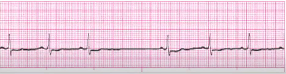 <p>Tx if symptomatic:<br>stop meds that cause, IV atropine if too slow, pacer if chronic</p>