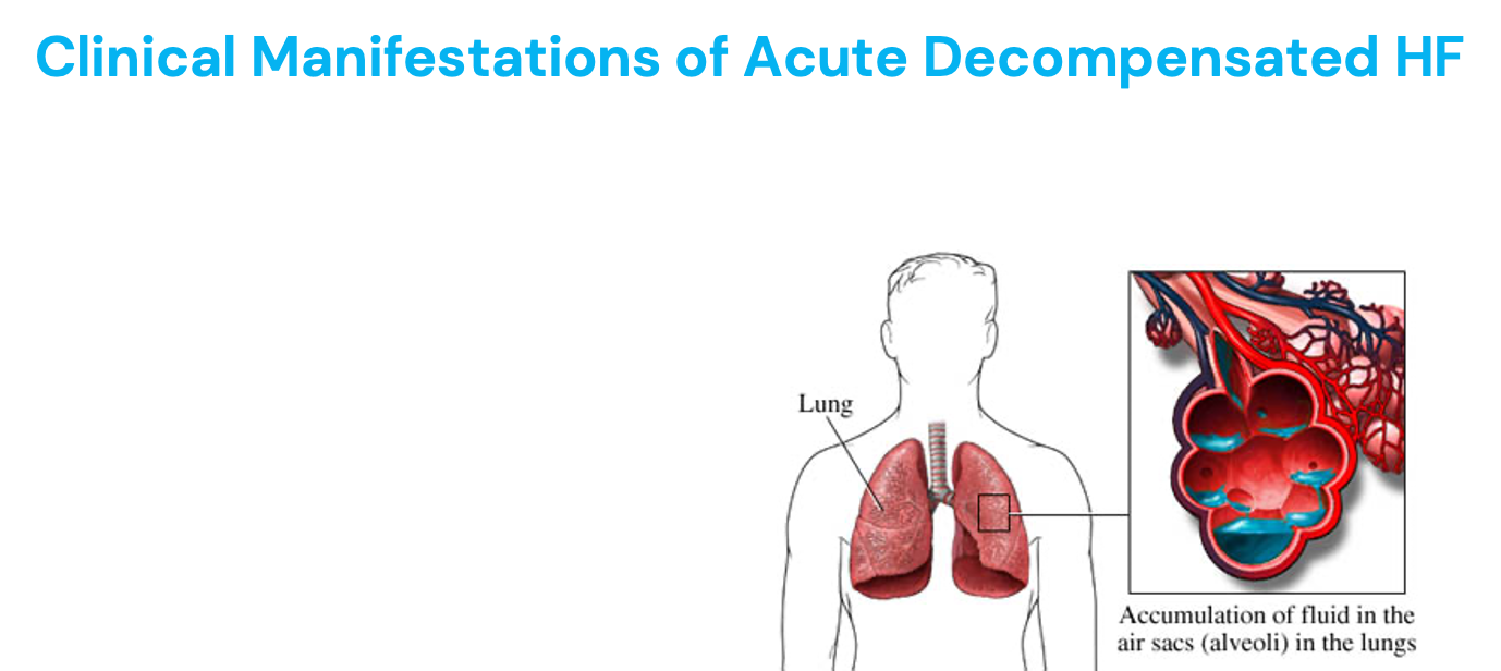 <ul><li><p>When HF becomes severe enough to cause symptoms requiring immediate treatment</p></li><li><p>Manifests as<strong> pulmonary edema and poor organ perfusion&nbsp;</strong></p><ul><li><p>Lungs alveoli become filled with fluid&nbsp;</p></li></ul></li><li><p>Signs and symptoms of pulmonary edema:&nbsp;</p><ul><li><p>Symptoms of low CO (body not perfused) = pale, weak, LOC, low blood pressure, low oxygen staturation, syncope&nbsp;</p></li><li><p>Anxious</p></li><li><p>Pale, possibly cyanotic</p></li><li><p>Skin is clammy and cold</p></li><li><p>Severe dyspnea</p></li><li><p>Wheezing, coughing, frothy/blood-tinged sputum</p></li><li><p>Crackles, wheezes, rhonchi</p></li><li><p>HR rapid, BP variable</p></li></ul></li><li><p>Causes: off meds, too much salt/water intake, alcohol use, pregnancy, infection/illness, arrythmia, ACS/MI</p></li><li><p>Tests ordered = echo (might shown low EF)&nbsp;</p><ul><li><p>&lt;25% severe&nbsp;</p></li><li><p>&lt;40% abnormal&nbsp;</p></li></ul></li><li><p>Treatment</p><ul><li><p>Diurectic = decrease preload&nbsp;</p></li><li><p>If BP elevated = decreade afterload + inotropic meds</p></li></ul></li></ul><p></p><p>*Worse! EMERGENCY!</p>