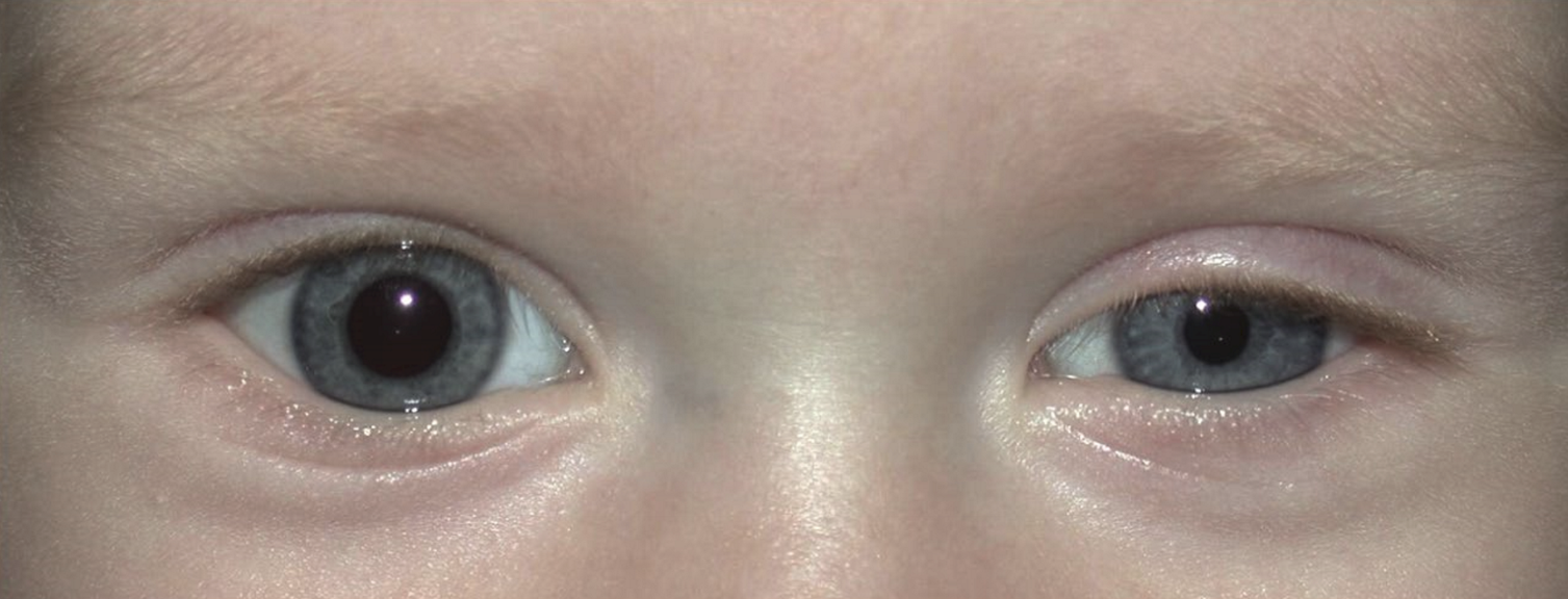 <p>A neurological condition caused by disruption of the sympathetic nerves supplying the eye and surrounding structures </p>