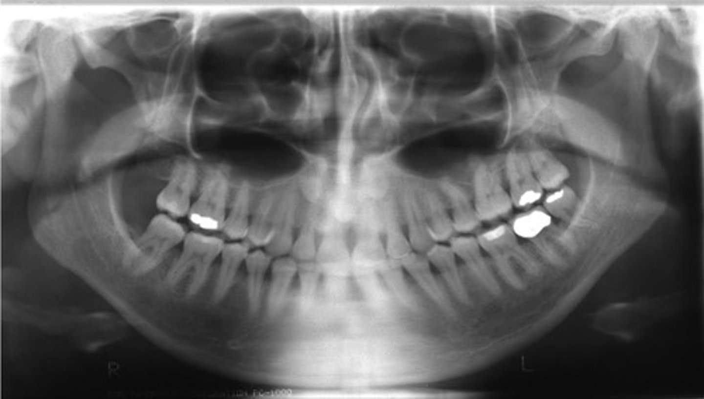 <p>What error caused the anterior teeth appear wide and blurred?</p>